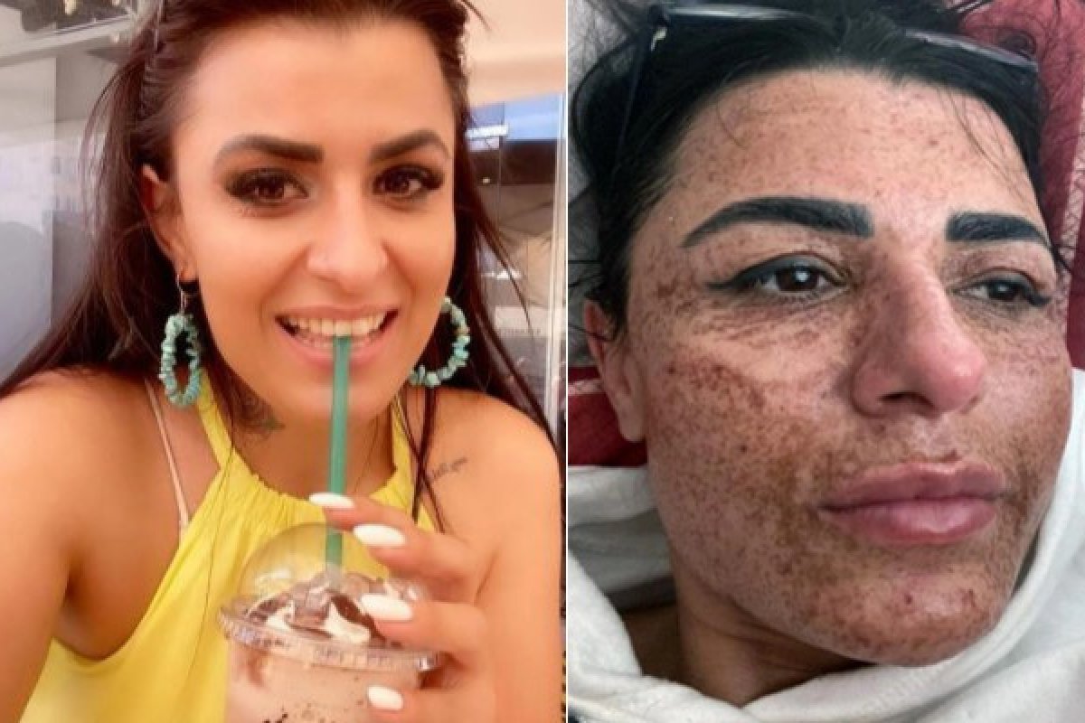 Mulher fica com cicatrizes no rosto após distração de esteticista