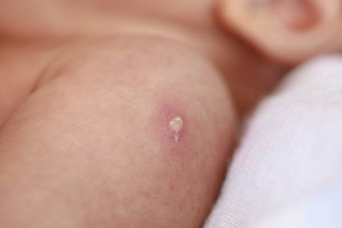 Cidades do interior da Bahia têm estoque zerado de BCG, vacina contra a tuberculose