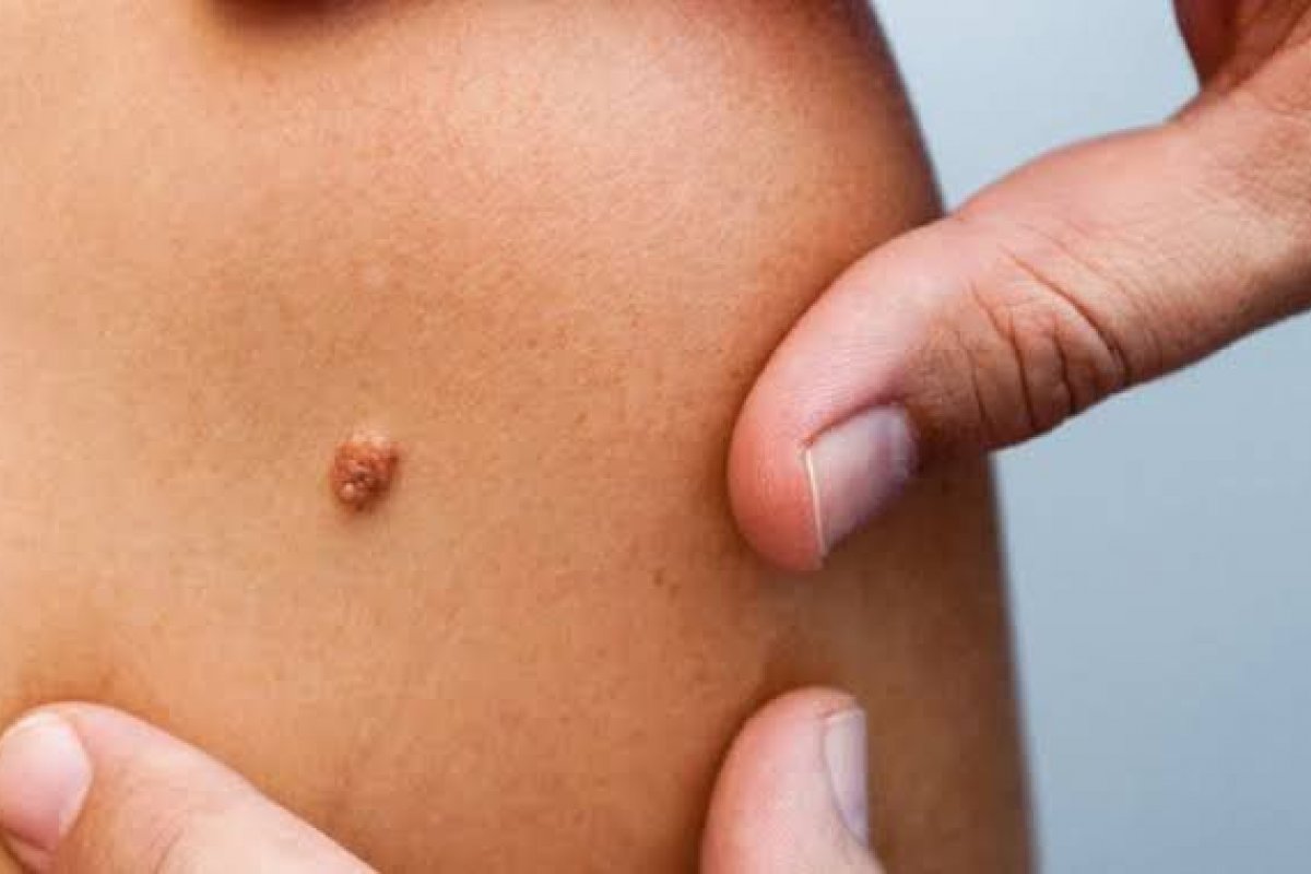 Câncer de pele - O risco de deixar para depois da pandemia